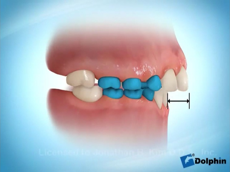 دکتر درانی متخصص ارتودنسی-اصلاح اورجت درارتودنسی